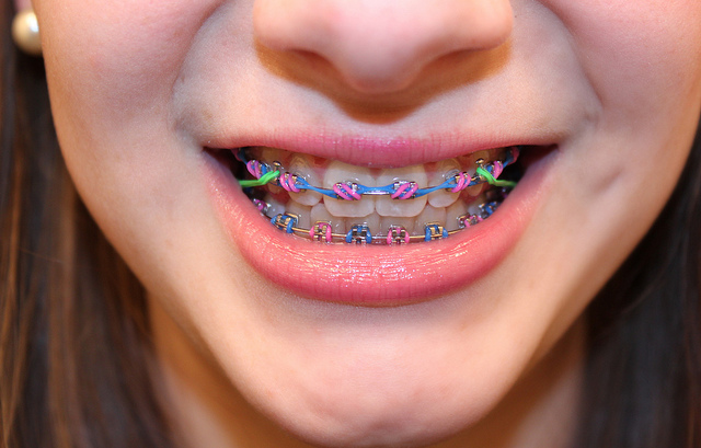 Is it really that bad to eat with rubber bands on your braces? - L&M Orthodontics - Orthodontists in Doylestown, Glenside, Perkasie, PA - Warrington, Bucks County, Montgomery County