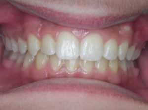 invisalign-2