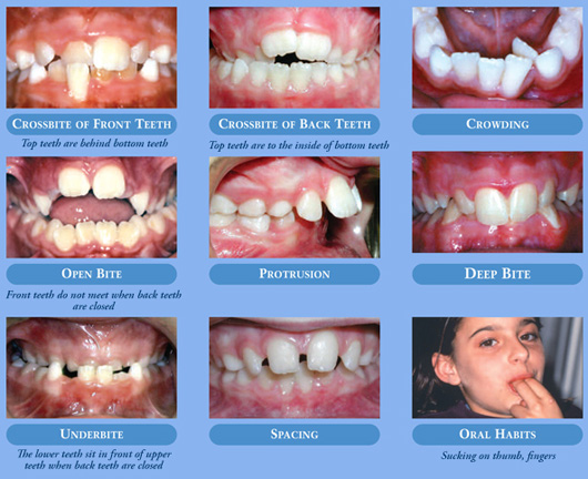 What's On My Teeth? - Girdwood Orthodontics