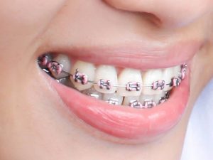 braces LMOrthodontics