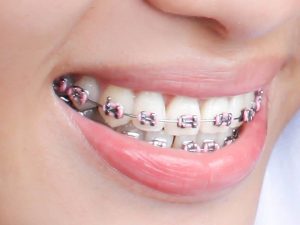 Routine Orthodontic Visit