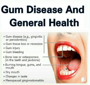 Image result for gum disease