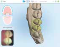 iTero Scanner at L&M Orthodontics