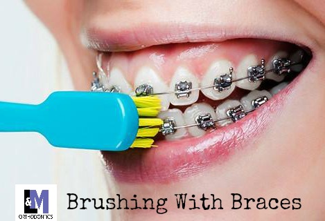 Proper Brushing with Braces