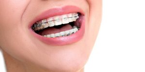 Type of Braces -Clear Braces