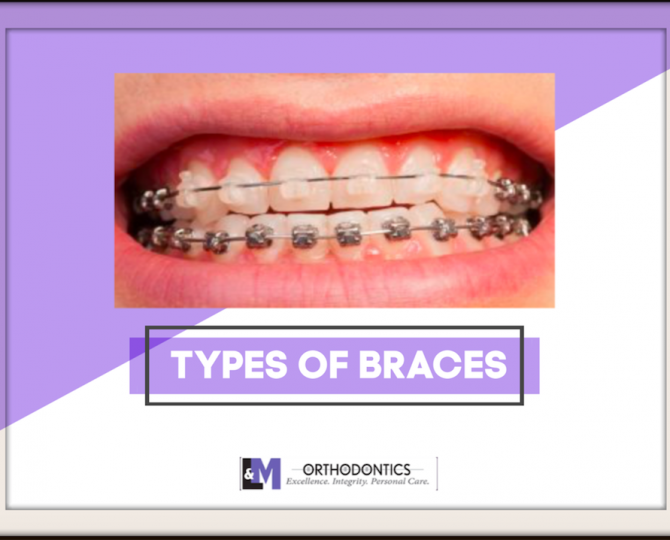 Types of Braces