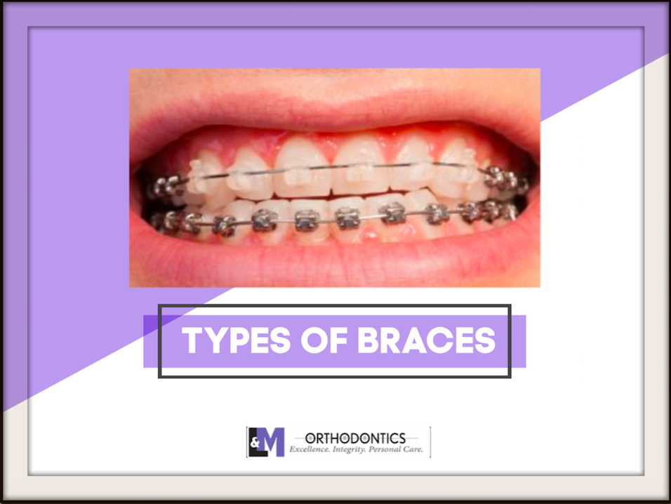 Types of Braces