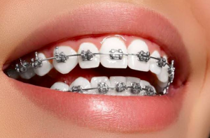 Metal Braces